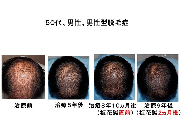 円形脱毛症　病院